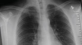 Akciğer Grafisi Nereden Alınır?