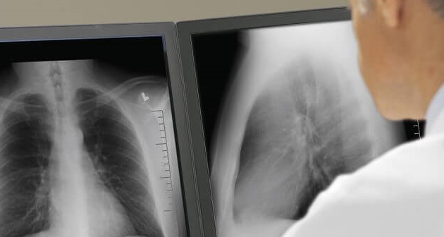 Akciğer Grafisi Nereden Alınır?